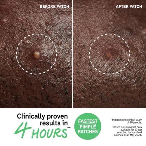 The INKEY List Hydrocolloid Invisible Pimple Patches